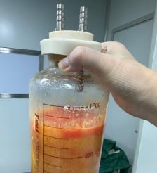 荆州水动力吸脂手术要做多久？